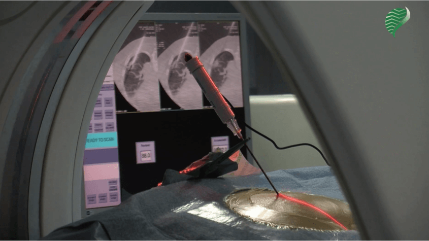 Lung radiofrequency ablation
