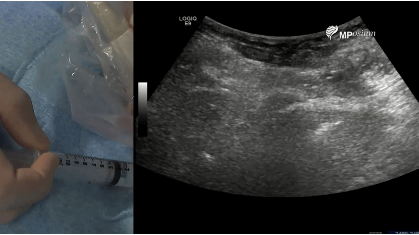 Liver microwave ablation of a sub capsular HCC with enhanced contrast ultrasound