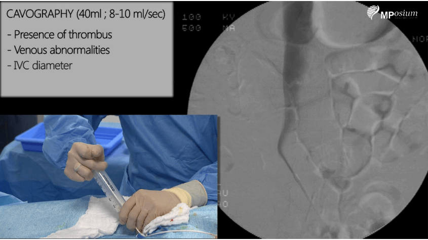 Inferior vena cava filter placement with femoral approach