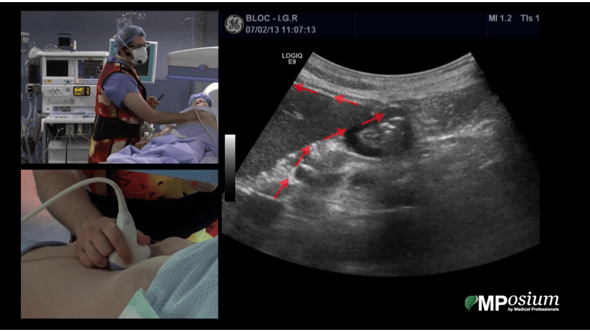 Percutaneous gastrostomy under fluoroscopic guidance