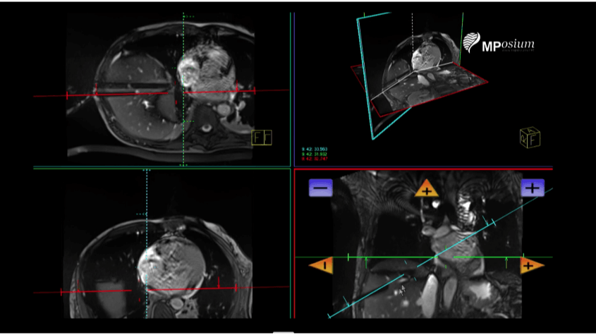 Liver cryotherapy under MRI Guidance