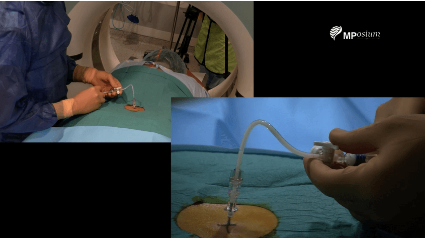 L4-L5 right epidural injection