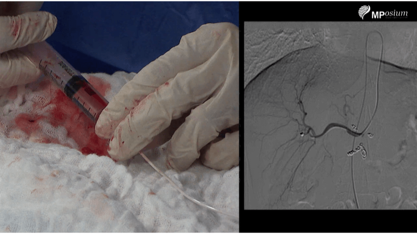 Repositioning of a displaced  catheter