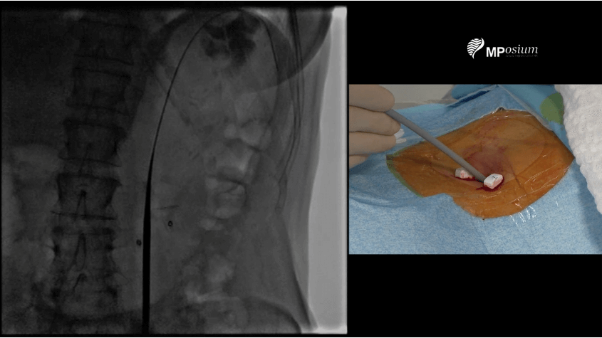 Gastrostomy tube placement