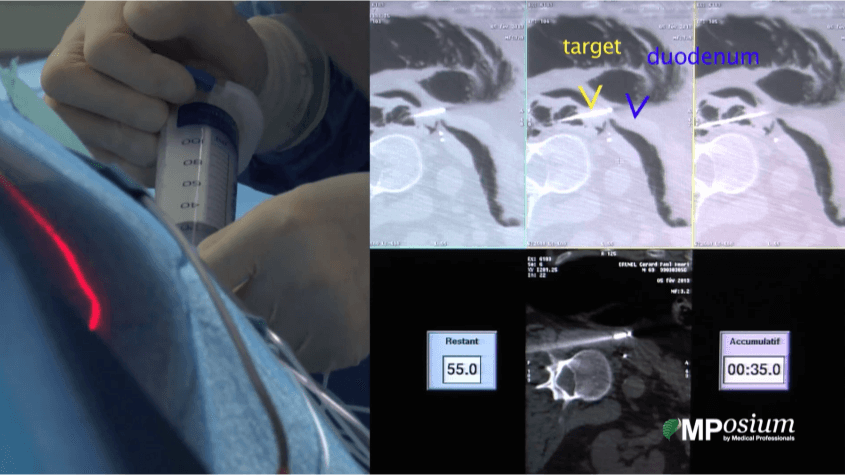 CT guided cryoablation of retroperitoneal recurrence of renal cell carcinoma
